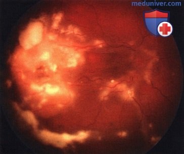 Примеры хеморедукции, субконъюнктивального введения карбопластина при ретинобластоме