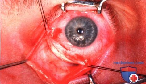 Кавернозная гемангиома глазницы