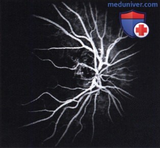 Примеры кавернозной гемангиомы сетчатки прорастающей диск зрительного нерва