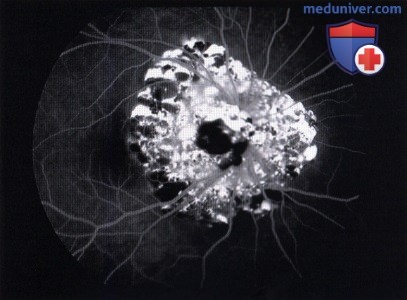 Примеры кавернозной гемангиомы сетчатки прорастающей диск зрительного нерва