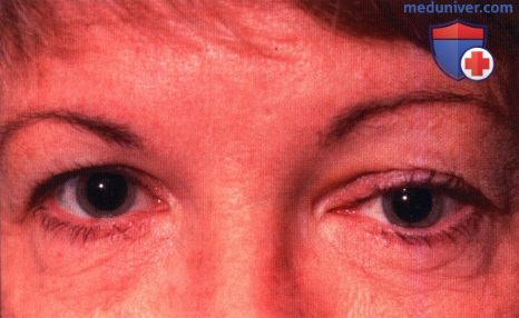 Первичная киста глазницы конъюнктивального происхождения