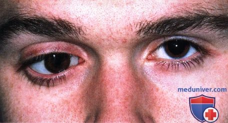 Первичная киста глазницы конъюнктивального происхождения