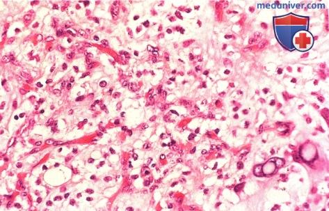 Примеры клинико-патологической корреляции гемангиобластомы сетчатки