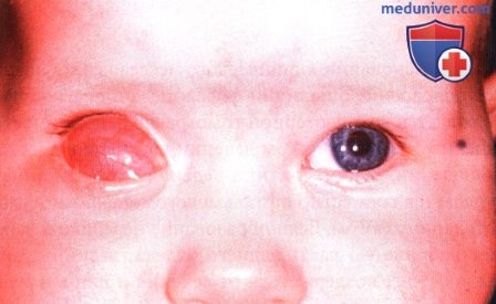 Колобоматозная киста глазницы (микрофтальм с кистой)