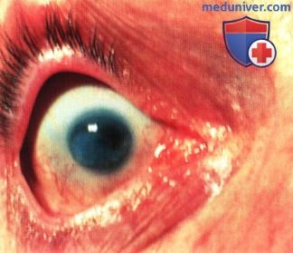 Колобоматозная киста глазницы (микрофтальм с кистой)