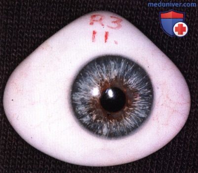 Примеры конформатора и протеза глаза применяемые после энуклеации