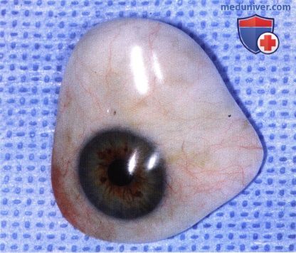 Примеры конформатора и протеза глаза применяемые после энуклеации