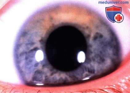 Ювенильная ксантогранулема и лангергансоклеточный гистиоцитоз сосудистой оболочки глаза
