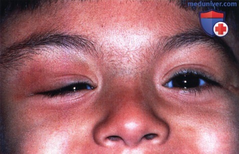Лангергансоклеточный гистоицитоз глазницы (эозинофильная гранулема)