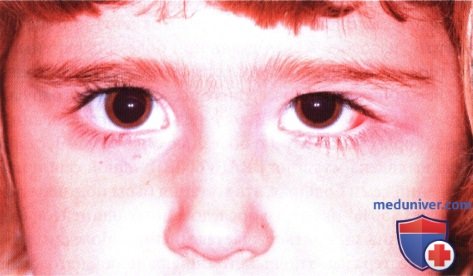 Лангергансоклеточный гистоицитоз глазницы (эозинофильная гранулема)