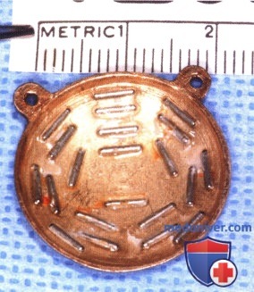 Пример установки радиоактивного аппликатора для лечения крупной цилиохориоидальной меланомы