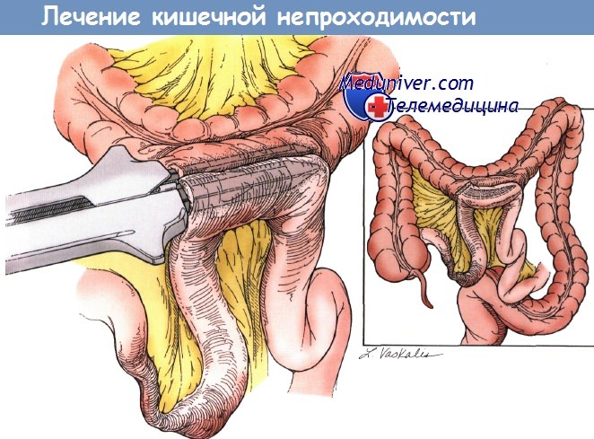 Синдром раздраженного кишечника после лучевой терапии thumbnail