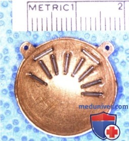 Пример установки радиоактивного аппликатора для лечения меланомы радужки