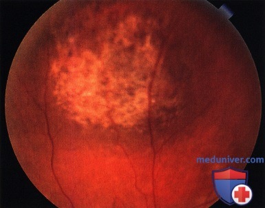 Методы лечения меланомы заднего отдела сосудистой оболочки глаза