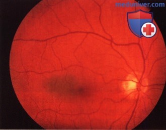 Методы лечения меланомы заднего отдела сосудистой оболочки глаза