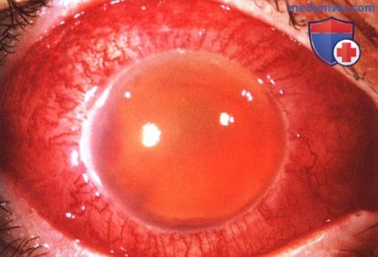 Лимфома сосудистой оболочки глаза