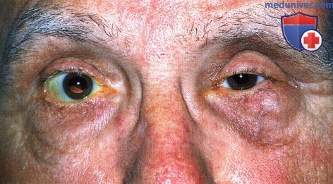 Лимфома века глаза