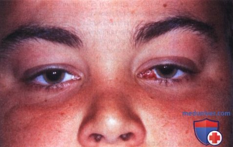 Посттрансплантационное лимфопролиферативное расстройство глазницы