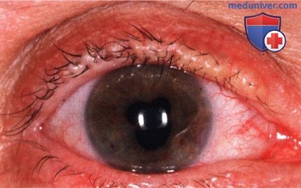 Липоидный протеиноз (болезнь Urbach-Wiethe) века глаза