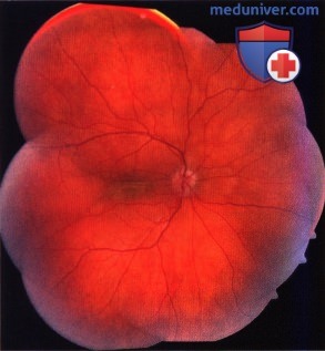 Примеры лучевой терапии лимфомы сосудистой оболочки глаза