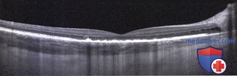 Примеры лучевой терапии лимфомы сосудистой оболочки глаза
