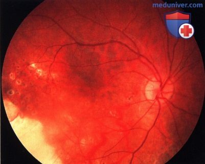 Примеры лучевой терапии ретинобластомы
