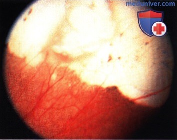 Примеры лучевой терапии ретинобластомы