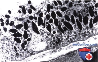 Мультифокальная врожденная гипертрофия пигментного эпителия сетчатки (ПЭС, медвежьи следы)