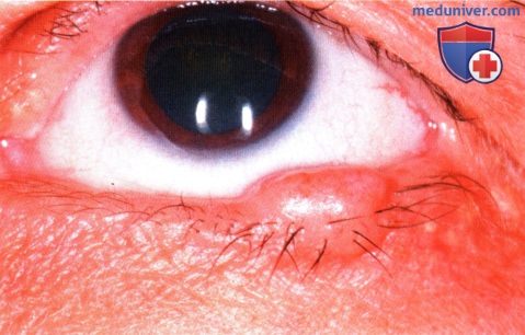 Меланоцитарный невус века глаза
