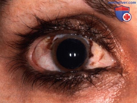 Меланоцитарный невус века глаза