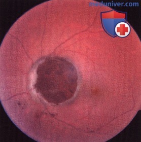 Меланоцитома диска зрительного нерва и сосудистой оболочки