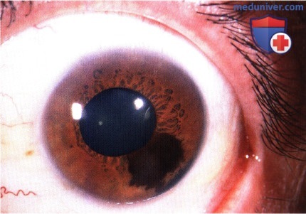 Меланоцитома диска зрительного нерва и сосудистой оболочки