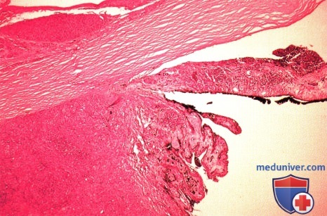 Меланома цилиарного тела и хориоидеи