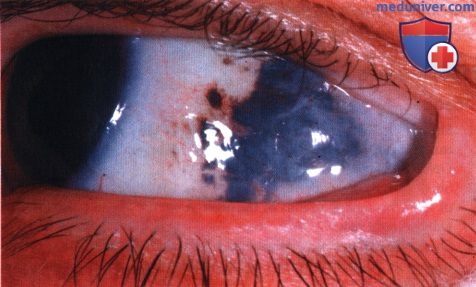 Меланома глазницы развившаяся из глазного меланоцитоза и голубого невуса
