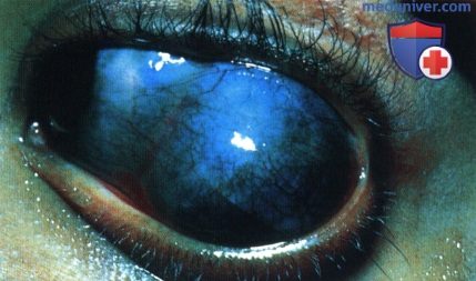 Меланома глазницы развившаяся из глазного меланоцитоза и голубого невуса