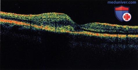 Примеры хориоидальной мембраны, симулирующей меланому хориоидеи