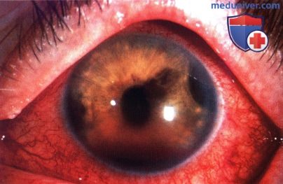 Как лечат меланомы глаза в Израиле