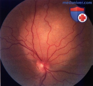 Метастатические опухоли сосудистой оболочки глаза, сетчатки и диска зрительного нерва