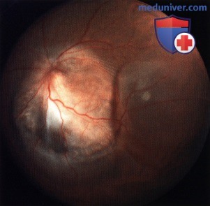 Метастатические опухоли сосудистой оболочки глаза, сетчатки и диска зрительного нерва