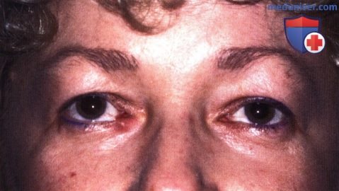 Метастатические опухоли века глаза