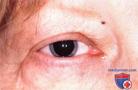 Метастатические опухоли века глаза