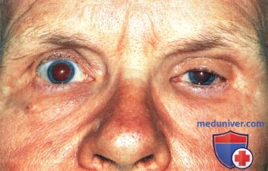 Метастатический рак глазницы