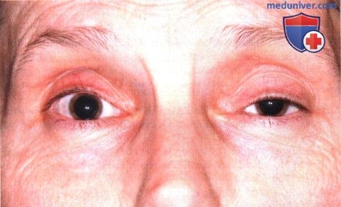 Метастатический рак глазницы