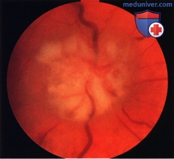 Примеры метастаза в диск зрительного нерва