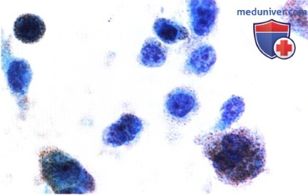 Примеры метастаза в сетчатку и стекловидное тело