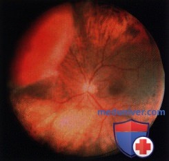 Примеры метастаза саркомы в сосудистую оболочку глаза