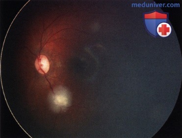 Методы диагностики ретинобластомы