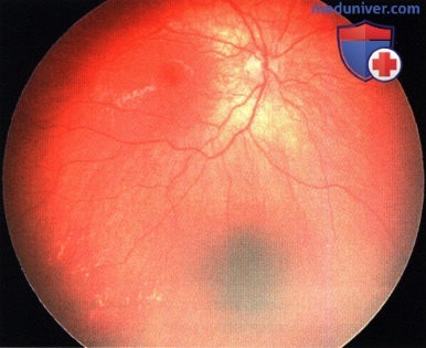 Примеры недержания пигмента симулирующего ретинобластому