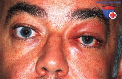 Идиопатическое негранулематозное воспаление глазницы (воспалительный псевдотумор, синдром идиопатического воспаления глазницы)