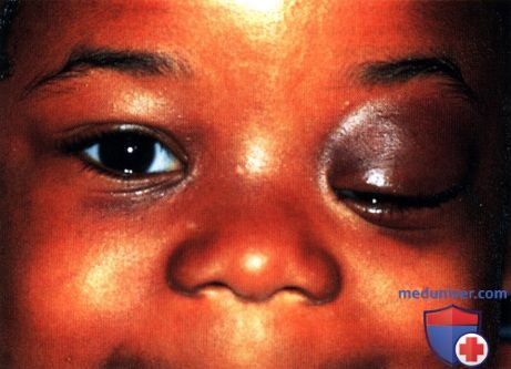 Идиопатическое негранулематозное воспаление глазницы (воспалительный псевдотумор, синдром идиопатического воспаления глазницы)